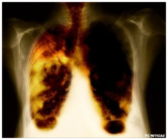 Enfisema pulmonar: causas, sintomas, tratamento e prevenção.