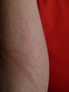 Alergia a sabão em pó sintomas e tratamentos - Fc Noticias