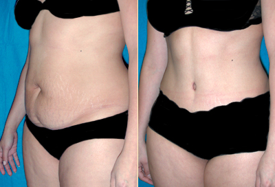 Antes e depois da abdominoplastia