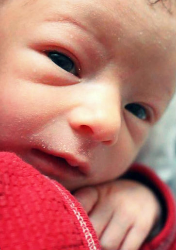 Lábio leporino: tira dúvidas