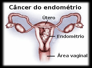 Causas, diagnóstico, sintomas e tratamento do câncer no endométrio.