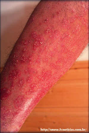 Psoríase tratamento natural caseiro