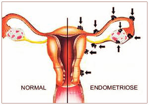 Endometriose: causas, sintomas, tratamento e prevenção.