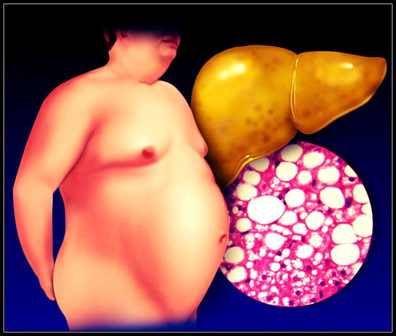 Esteatose hepática: causas, sintomas, tratamento, prevenção, dicas de alimentos.