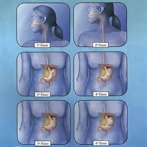 BIB, balão intragástrico, perda de peso, efeitos colaterais, vantagens, preço.