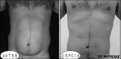 Antes e depois de uma lipoaspiração masculina
