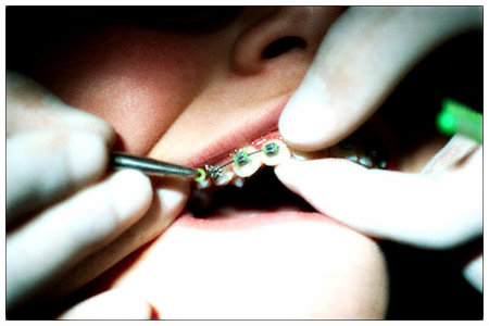 Aparelho ortodôntico: informações e dicas.