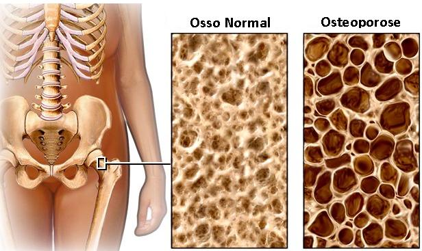 Osso normalxosso com osteoporose