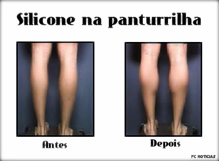 Antes e depois de colocar silicone nas panturrilhas