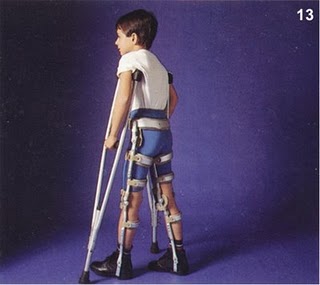 Paralisia, tratamento.