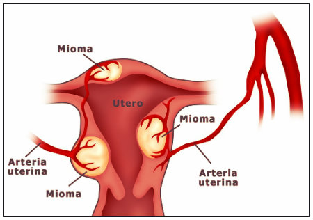 Miomatose uterina: causas, sintomas, tratamento e prevenção.