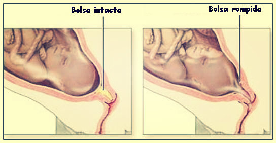 Com quantas semanas a bolsa amniótica pode vir a romper?