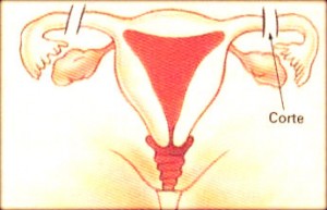 Tira dúvidas sobre a reversão da laqueadura tubária.