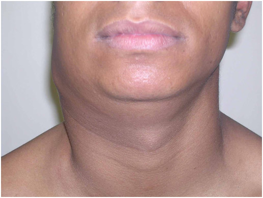Retratação da tuberculose óssea. (Foto: Reprodução)