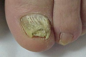 Unha com Micose. onicomicose