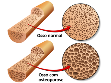 Demonstração gráfica da osteoporose Demonstração gráfica da osteoporose