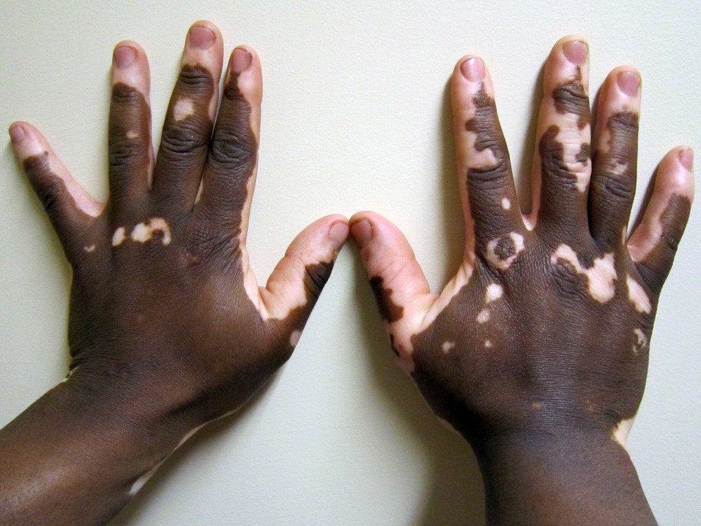 vitiligo uma doença de pele benigna