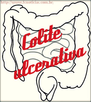 Colite ulcerativa, sintomas